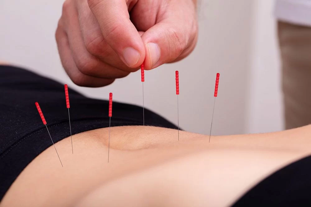 Agujas de acupuntura clavadas en el estómago de una persona 