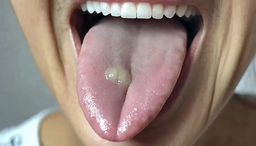 Verruga de VPH en la lengua